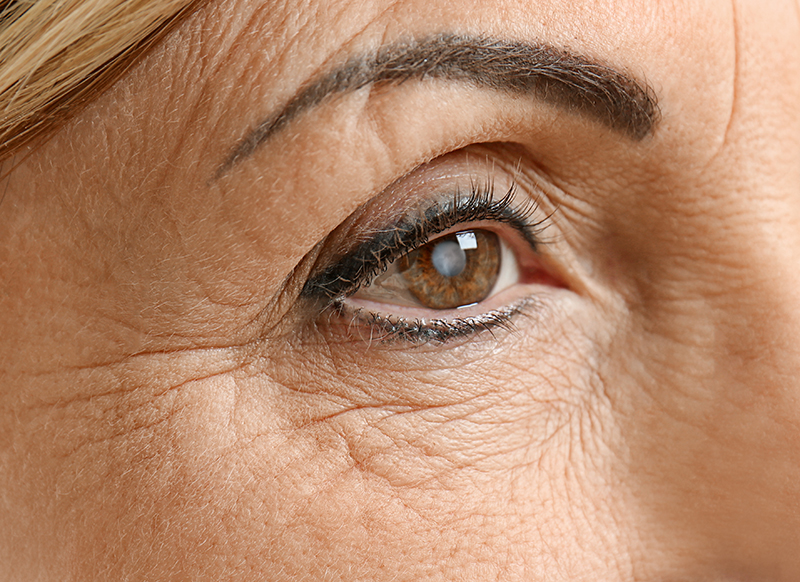 Cataract concept. Senior woman's eye, closeup