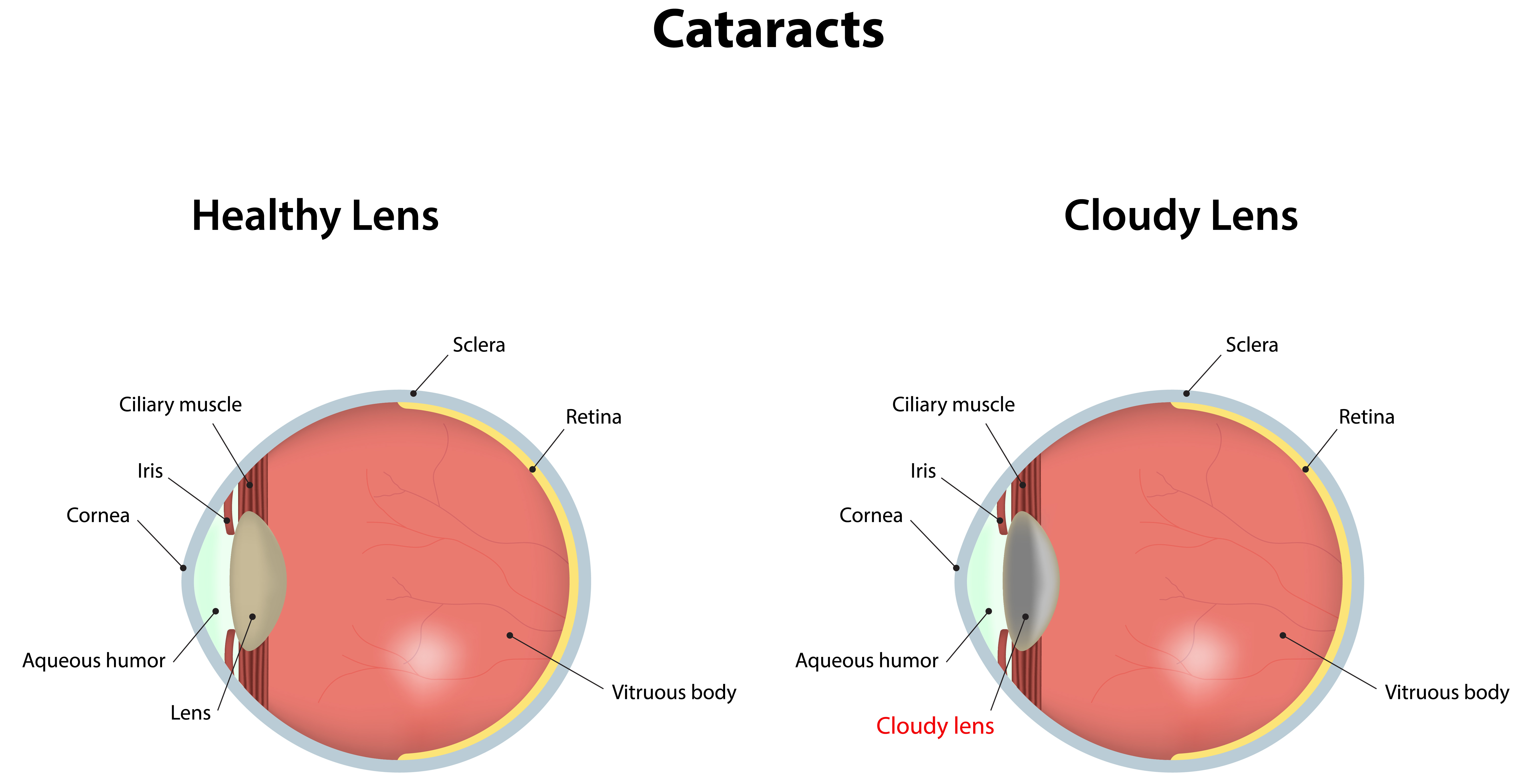 Cataract Surgery Eye Drops Chart