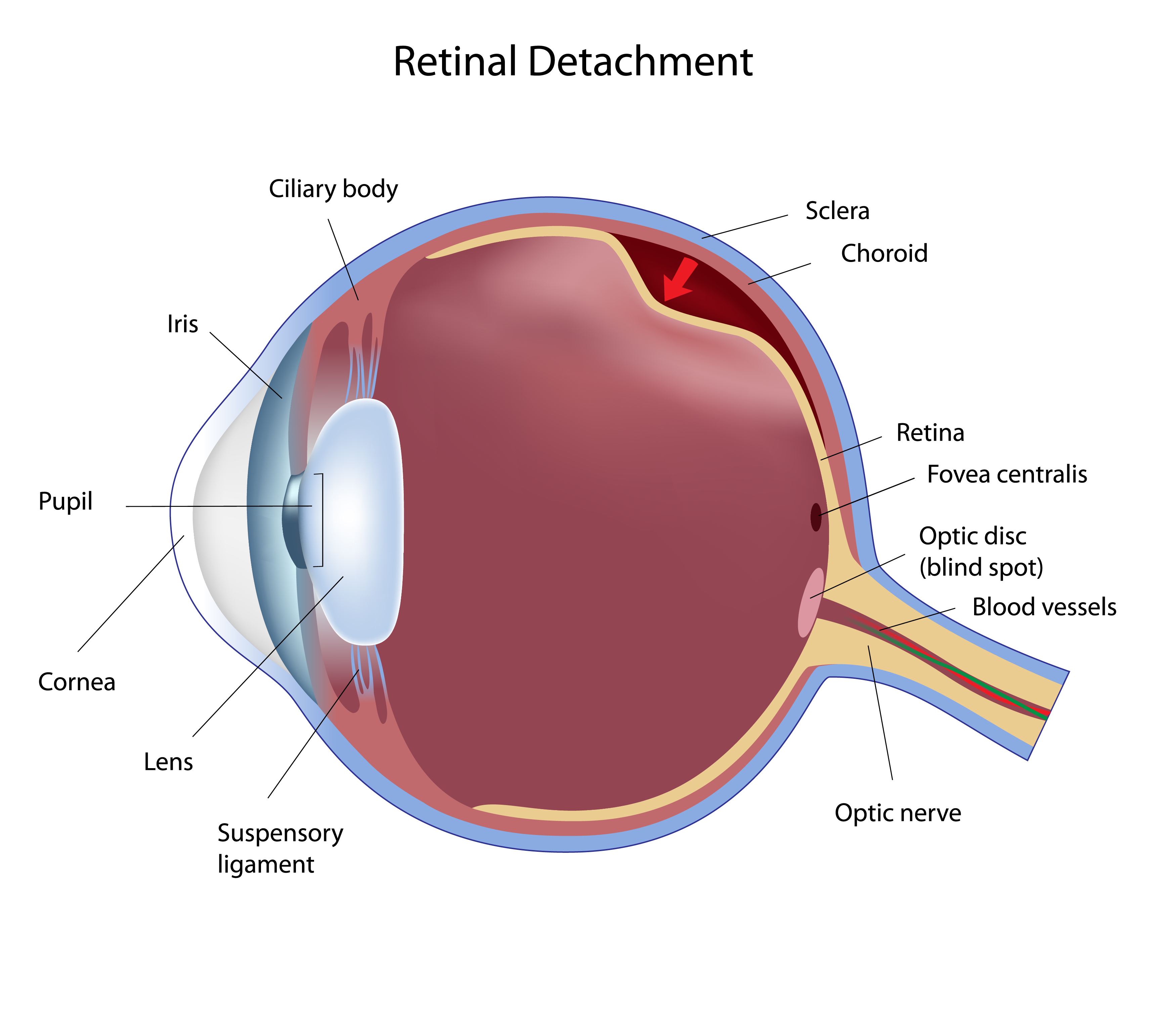 Retinal Detachment - Louisiana Eye & Laser