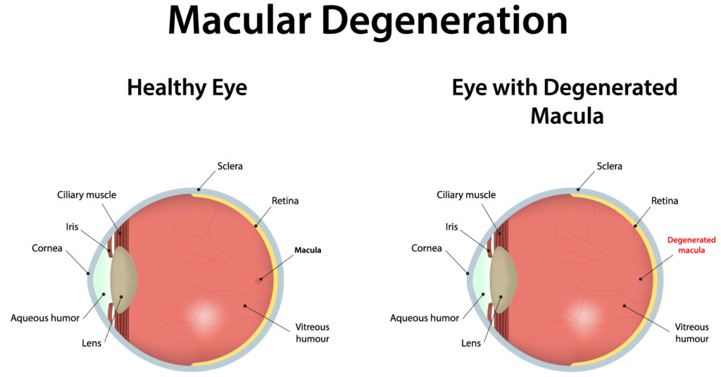 Macular Degeneration comparison example