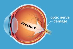 glaucoma diagram