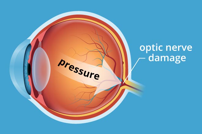 optic nerve glaucoma