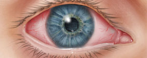 conjunctivitis