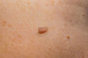 skin tags