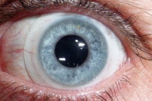 What is a scleral lens?