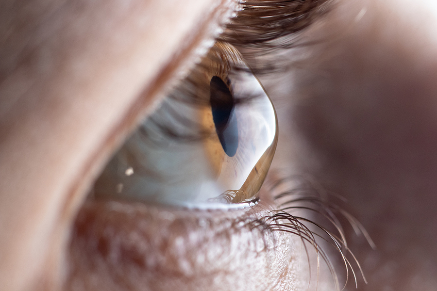 Macro Eye Photo. Keratoconus - Eye Disease, Thinning Of The Corn